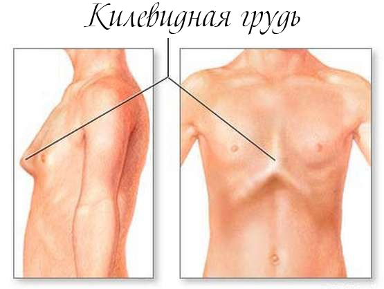 килевидная деформация грудной клетки (килевидная грудь)