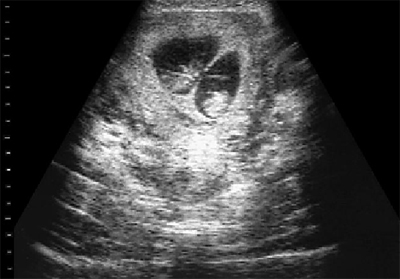 беременность двойней УЗИ