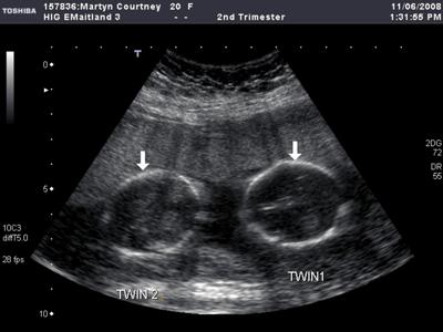 УЗИ беременности двойней на 15 неделе